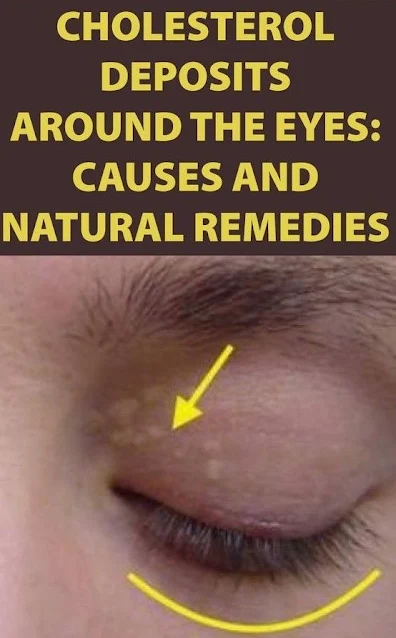 Causes And Natural Remedies For Cholesterol Deposits Around The Eyes