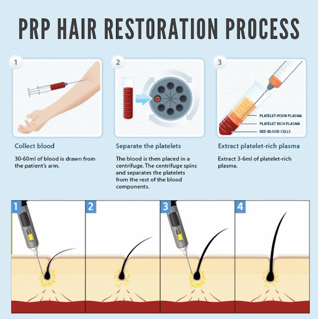 PRP Hair Restoration Process | Best Hair Transplants