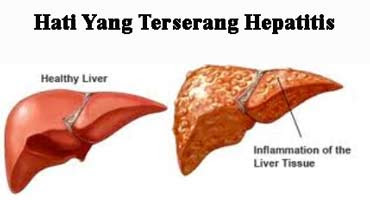 Gejala Virus Hepatitis Dan Cara Menyembuhkan