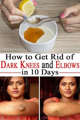 How To Get Rid Of Dark Knees And Elbows In 10 Days