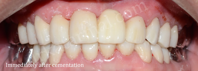 After Cementation of Full Mouth Crowns