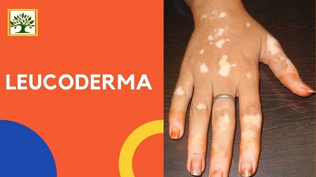 skin disease treatment