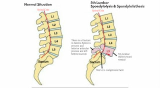 Lumbar spondylolisthesis