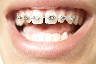Đặc điểm của răng khểnh 
