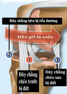 Cách nhận biết đứt dây chằng chéo đầu gối sau