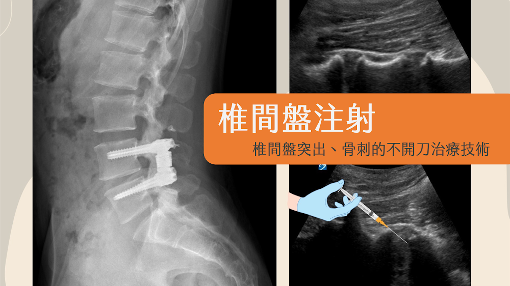 椎間盤注射治療