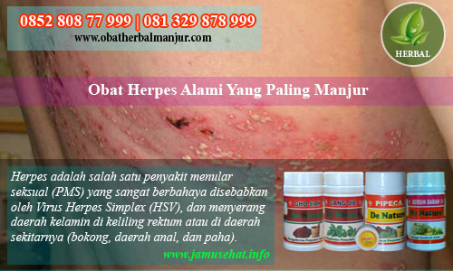 cara menghilangkan penyakit herpes