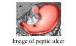 Peptic Ulcer