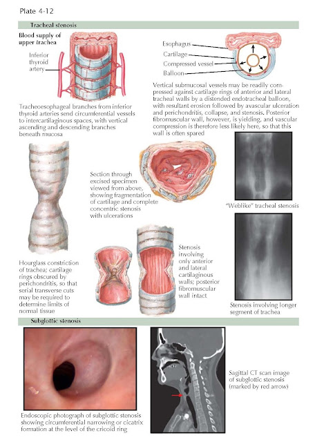 LARYNGEAL AND TRACHEAL STENOSIS