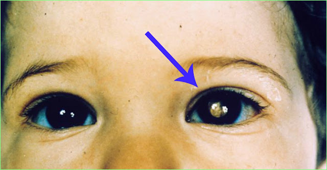 Awas, Kenali Gejalanya !! Bahaya Penyakit Mata Mengerikan Pada Bayi Seperti Berikut Ini 