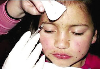 8-letnia dziewczynka, której matka wstrzykuje botoks. An 8-year-old girl whose mother injects botox.