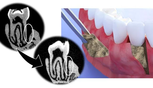 Periodontal Disease Therapeutics