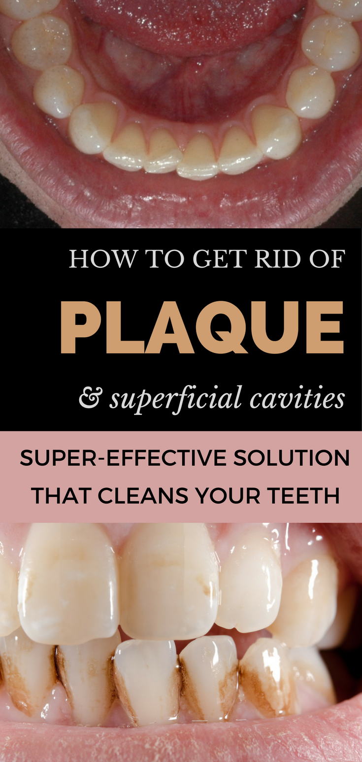 How to Get Rid of Plaque and Superficial Cavities at Home