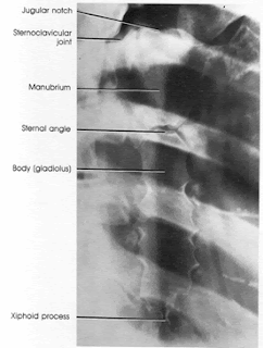 Radiology Lecture Notes: Sternum, Clavicle & Ribs