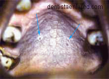 <Img src ="autoexamen-paladar.jpg" width = "220" height "160" border = "0" alt = "´Paladar de fumador (estomatitis nicotínica)">