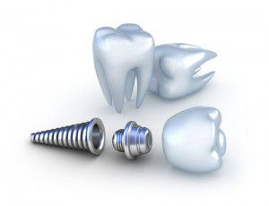 Tìm hiểu về cấu trúc răng Implant nha khoa