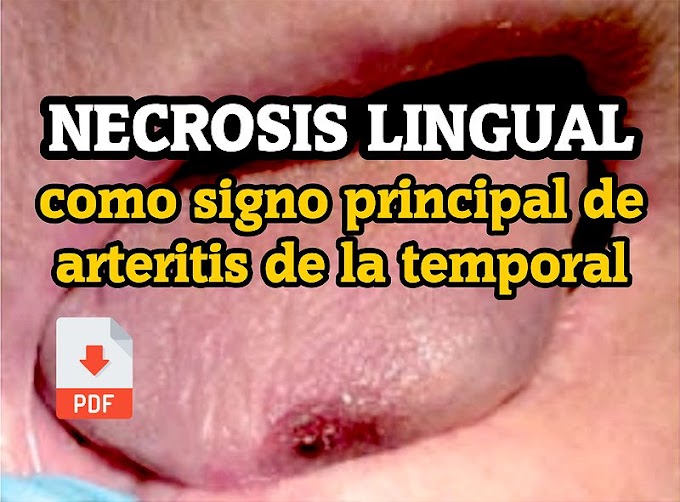 PDF: Necrosis Lingual como signo principal de Arteritis de la Temporal