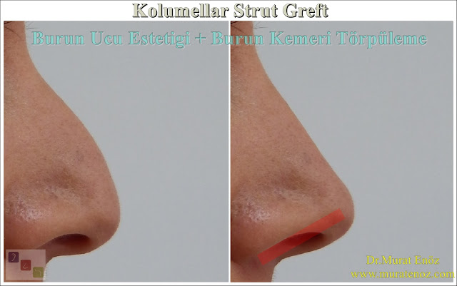 Nose tip stiffness after nasal tip surgery - Why nose tip become harden after nose tip plasty? - Nose tip sagging - Droopy nose tip- Nose tip sag when smiling - Nose tip drop - What is the columellar strut graft? - How does columellar strut grafts work? - How is the columellar strut graft placed? - Nose tip aesthetics - Nose tip lifting