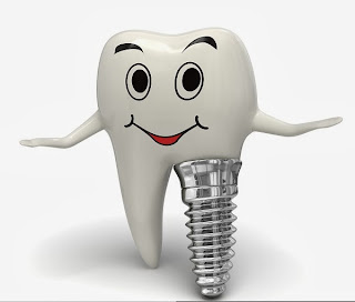 http://dentist-india-delhi.com/Dental-Implants.php