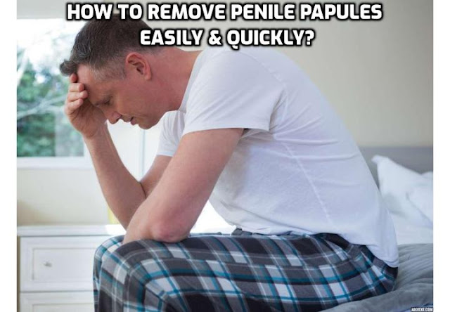 Preventing and Treating Pearly Penile Papules – Living with pearly penile papules can be a hard and traumatizing experience. Learn how you can get rid of them in an easy and safe way. Read on here to discover the Pearly Penile Papules Natural Home Treatment Program that offers the safest and easiest way to get you rid of those ugly pearly penile papules so that you can forget about those bumps which are so much troubling your life. 