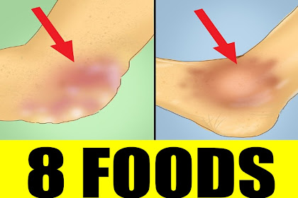 8 FOODS CAN LOWER URIC ACID