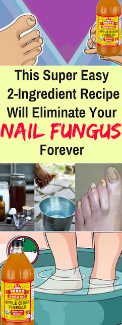 This Super Easy 2-Ingredient Recipe Will Eliminate Your Nail Fungus Forever