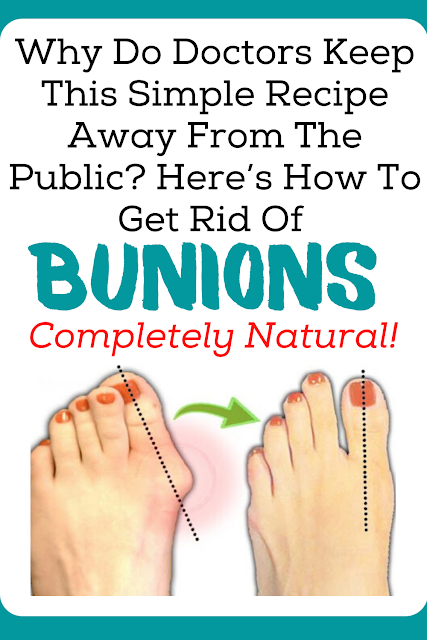 Why Do Doctors Keep This Simple Recipe Away From The Public? Here’s How To Get Rid Of Bunions Completely Natural!