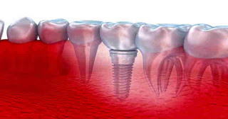 Implantes dentários vantagens e desvantagens
