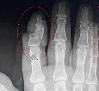 el parmak kırığı röntgen
