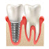 Saiba quanto custa um implante dentário