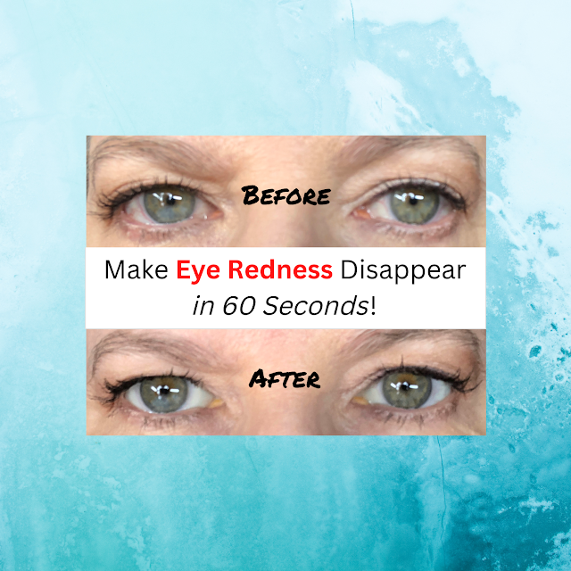 Make Eye Redness Disappear in 60 Seconds - Before and After close up photos of eyes