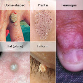 types of warts