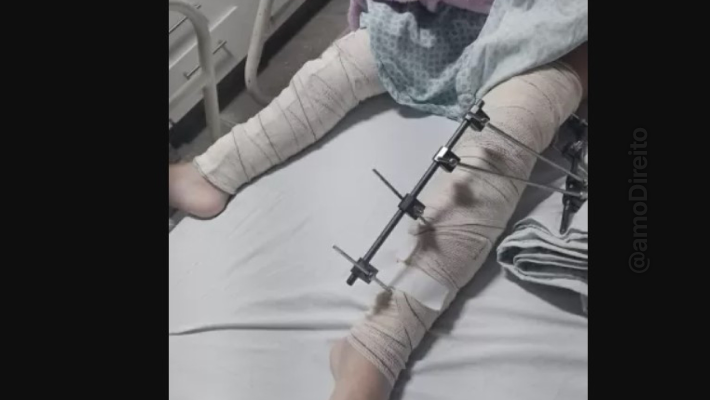 menina 6 anos pinos colocados perna errada