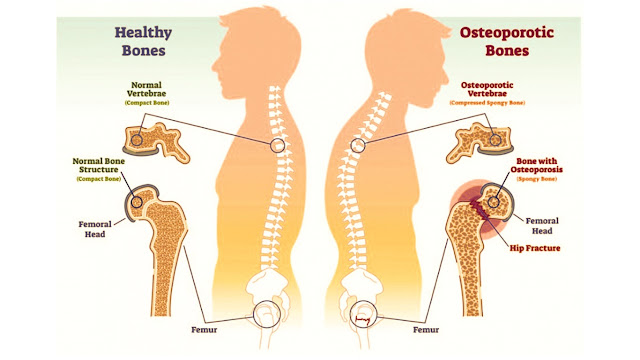 Osteoporosis Fracture Treatment | Osteoporosis Bone Surgery