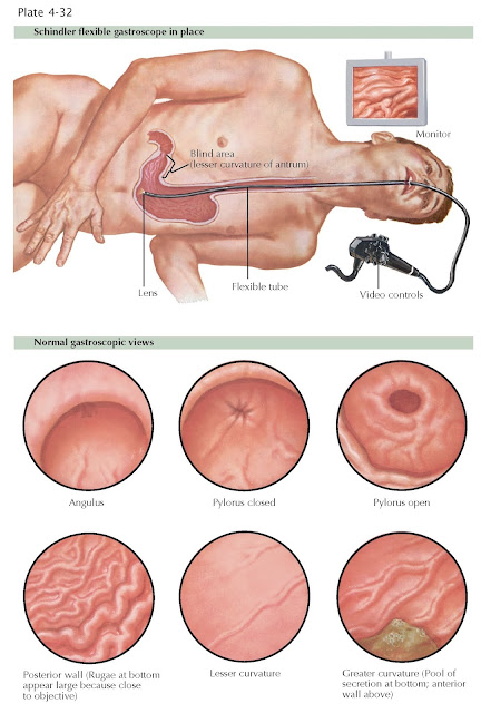 ENDOSCOPIC EVALUATION OF THE STOMACH: UPPER ENDOSCOPY