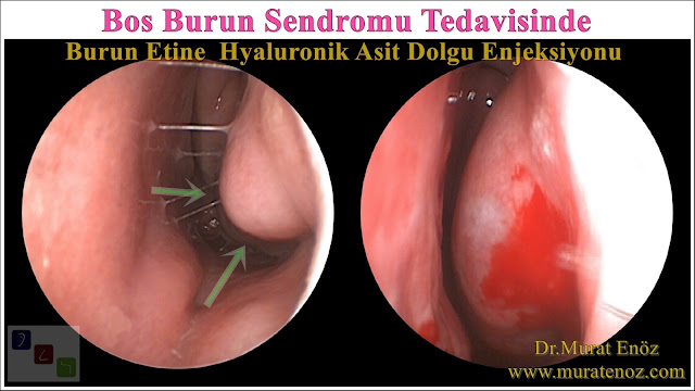 Boş Burun Sendromu Tedavisinde Hyaluronik Asit İle Burun Eti Dolgusu 