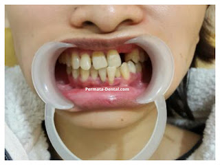 Gambar gigi yang akan memakai gigi crown di permata dental  bali| pasang gigi palsu crown cepat di permata dental  bali | pasang gigi palsu crown bagus di permata dental  bali | pasang gigi palsu crown murah di permata dental  bali | pasang gigi palsu crown aman di permata dental  bali | pasang gigi palsu crown geraham di permata dental  bali | pasang gigi palsu crown mudah di permata dental  bali | pasang gigi palsu crown permanen |harga  pasang gigi palsu crown di permata dental  bali | pasang gigi palsu crown di ahli gigi  permata dental  bali | pasang gigi palsu crown depan di permata dental  bali | pasang crown pada gigi di permata dental  bali | trend foto gambar gigi palsu crown | pasang gigi palsu crown promo di permata dental  bali | pasang gigi Crown 2017 | cara pasang gigi crown di permata dental  bali | sebelum dan sesudah pasang gigi palsu crown di permata dental  bali | pasang gigi palsu permanen bali | pasang gigi palsu permanen banyuwangi | pasang gigi palsu permanen nusa dua | pasang gigi palsu permanen jimbaran | pasang gigi palsu permanen kute | pasang gigi palsu permanen denpasar | pasang gigi palsu permanen badung | pasang gigi palsu permanen denpasar | pasang gigi palsu permanen  singaraja | pasang gigi palsu permanen  balung | pasang gigi palsu permanen murah |  pasang gigi palsu permanen mudah | pasang gigi palsu permanen  cepat | pasang gigi palsu permanen bagus | pasang gigi palsu permanen geraham | pasang gigi palsu permanen depan | pasang gigi palsu bawah | pasang gigi palsu atas | pasang gigi palsu baik| pasang gigi palsu dewasa |