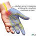 Carpal Tunnel Syndrome