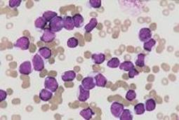 Leukemia Limfoblastik Akut (ALL) ~ Informasi Kedokteran 