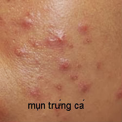 Mụn trứng cá