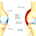 Rheumatoid arthritis