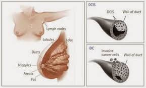 Penyebab dan gejala kanker payudara