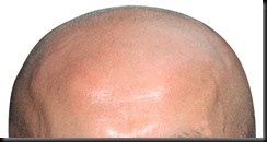 bald_big