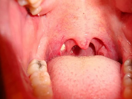 What causes White spot on tonsil