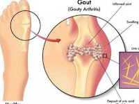 Mengobati Asam Urat Dengan Herbal