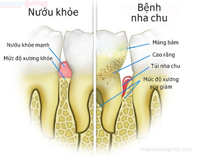 Bệnh nha chu là gì?