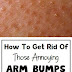 How To Get Rid Of Those Annoying Arm Bumps - Keratosis Pilaris