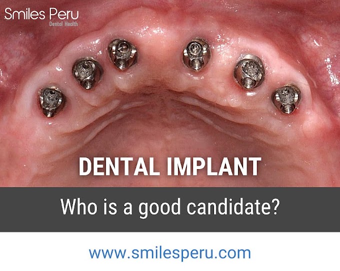 DENTAL IMPLANT: Who is a good candidate? - Smiles Peru