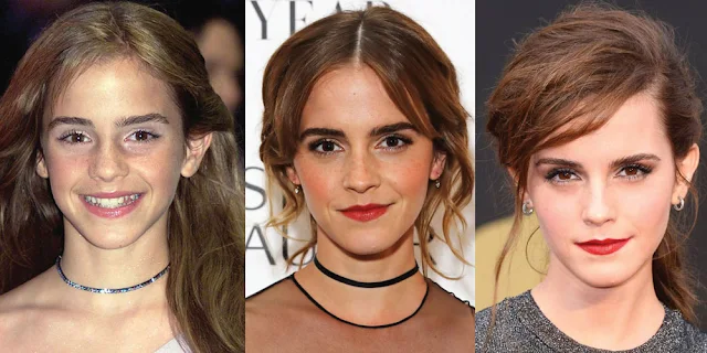 Emma Watson Plastic Surgery +Before And After
