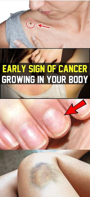 17 Warning Signs That Cancer is Growing in Your Body (Don’t Ignore Them!)